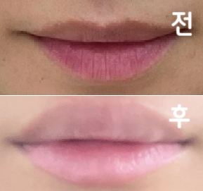 주사를 싫어해서 긴장했는데 다들 너무 친절하시고 생각보다 통증도 덜 했어요~