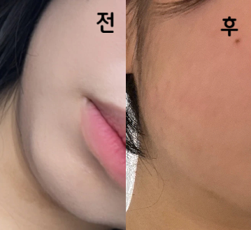 개인적으로 턱 살이 컴플렉스였는데 어느정도 줄어든 것 같습니다!