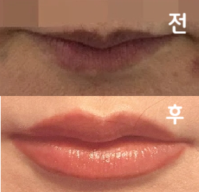 얇았던 입술이 자연스러운 느낌으로 부풀어 올라서 대만족입니다!