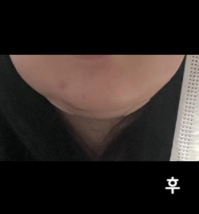 시술도 꼼꼼하게 해주시고 너무 좋았어요 경과보고 또 받으러 갈게용~