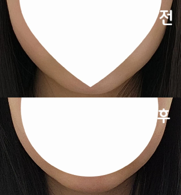 포키주사는 마취크림 없이도 별로 안 아프고 붓기도 금방 가라앉아서 좋았습니다:)