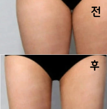세 달의 한 번씩은 꼭  맞는 거 같아요!