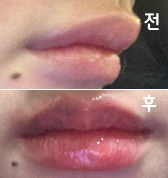 여기가 필러, 필러제거 맛집인가봐요~ 원장님이 한 땀 한 땀 찔러주셨습니다~ 촘촘히 잘 찔러 주셔서 감사했어요~