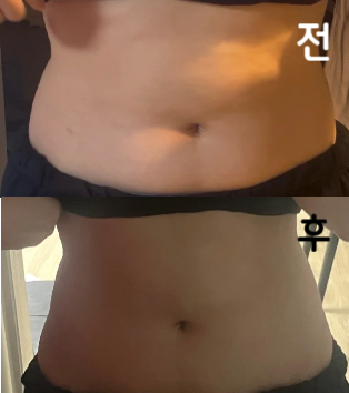 완전 만족 2+1으로 진행할걸 후회중입니다.. 돈 열심히 벌어서 또 맞으러 올게요...
