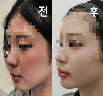 최적의 시술방법을 제안해 주셔서 만족스럽게 마무리 되었습니다~