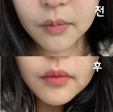포키 사랑할 수 밖에 없는 이유,, 가격도 저렴한데 효과도 좋고 친절하시구 ㅜㅜ 대기 좀 있지만 인기가 많으니 이해됨~