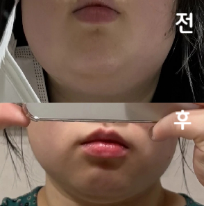 맞은 직후는 진짜 너무 웃기게 붓긴 했는데 맞은지 3일 됐는데 조금 갸름해진 것 같아요~