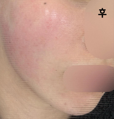 피부과를 많이 다녀본 건 아니지만 지금까지 가 본 곳 중에서 가장 친절하시고 가성비가 넘넘 좋습니당!