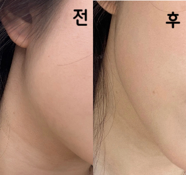 시술도 금방 끝났구 전체적으로 편한 분위기여서 좋았어요~