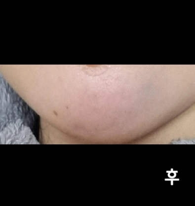 아직 붓기가 있어서 효과가 얼마나 있는지는 모르겠는데 말랑말랑해진게 거의 다 빠질 것 같아용~!