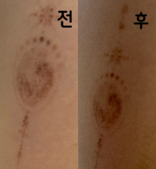 붉은기가 남아있는 흐린타투 이건 몇 회 더 하면 끝날 듯!