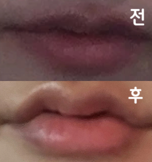 통통하게 입술 모양이 나온 것 같고 시술 전에 친절하게 원하는 모양 물어봐주셔서 좋았습니다!
