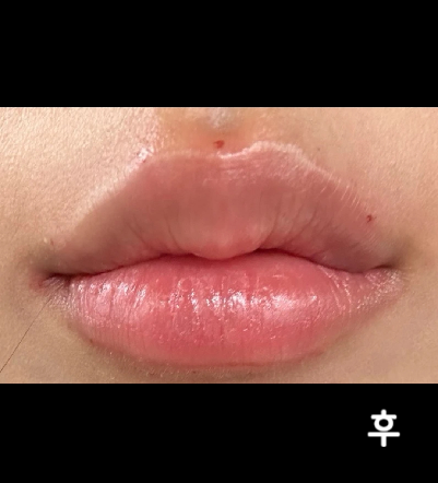 상담해주시는분 엄청 친절하게 해주시고 제가 원하는 입술 모양 잘 만들어주셨어요!! 만족합니다~