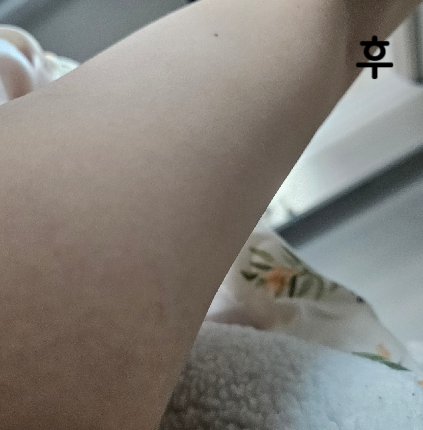 처음해봐서 겁 먹었는데 할만해요! 두 번 정도 더 받아보려구요~