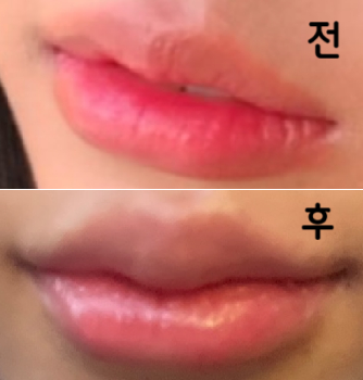 입술필러를 어디서 할까 고민하던 중 가격도 괜찮고 평도 좋은 여기로 선택했는데 역시 너무 이쁘게 잘 해주셔서 만족 중입니다!!