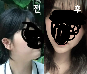 살 빠졌냐는 소리 엄청듣고 얼굴형도 바껴서 너무 만족합니다!!