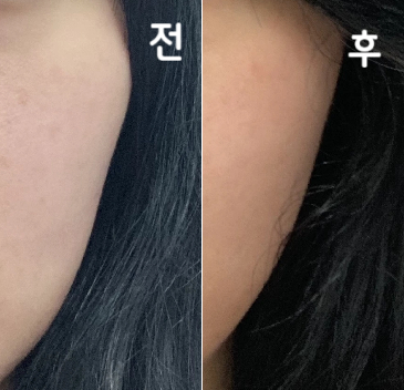 1차 때 금방 효과 좋았다가 몇 달 지나니까 살짝 돌아와서 또 여기서 2차 맞았어요!