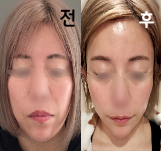 1년만에 실리프팅이었지만 상담도 원활하고 마무리도 만족합니다!