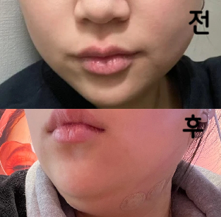여자쌤이셨는데 너무 친절하셔서 좋았어요 ㅎㅎ 또 갈 것 같아요 병원 강추입니다!