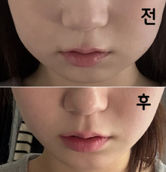 볼살이 너무 스트레스였어서 지방분해주사를 알아보던 중에 포키주사가 효과 좋다고 해서 맞아봤어요!