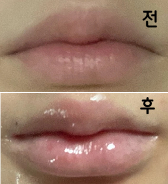 의사분이 정말 친절하시고 꼼꼼하게 안 아프게 해주세요 결과도 넘 만족입니다~