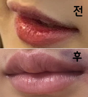 멍이 좀 들긴 했는데 이틀정도 안으로 잘 가라않았구 잘 녹았어용~