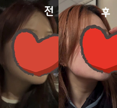확실히 고민이었던 턱살, 이중턱라인이 많이 정리된게 눈에 보였고, 화면에서도 슬림해진게 잘 보였어요~