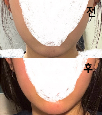 본인만 아는 전후 차이긴 하지만 저는추천드립니다~! 가격도 저렴하고 얼굴이 조금 정돈된 느낌입니다!