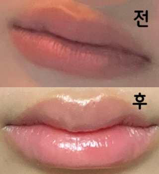 전에 1cc 입술 맞았는데 너무 자연스러워서 추가로 1cc 맞았어요!