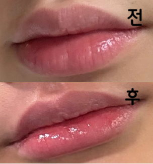 원장님께서 꼼꼼히 제가 원하는 모양대로 넣어주셔서 신뢰도 가고 결과가 너무 자연스럽고 만족스러운 거 같아요!!
