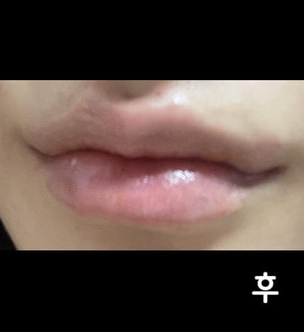상담도 너무 친절했지만 의사쌤도 밝으시고 저에게 맞는 디자인으로 예쁘게 필러 놔주셔서 너무 만족합니다 ㅎㅎ
