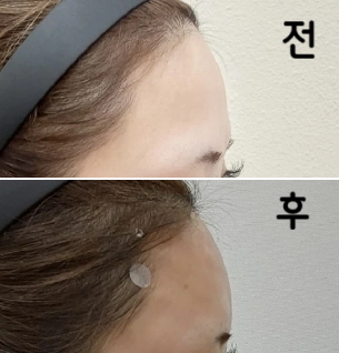 저렴한 가격에 정성스러운 상담을 해주셔서 이상의 시술을 받을 수 있었습니다!!