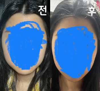 아직 하루차라 잘 모르겠는데 무너가 라인 정리가 된 듯한 느낌이 들어요! 직원들이 다 너무 친절했고 병원도 넘 깔끔했어용 ㅎㅎ