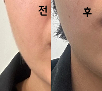 효과 있어서 4회차 맞으러 왔습니다!!