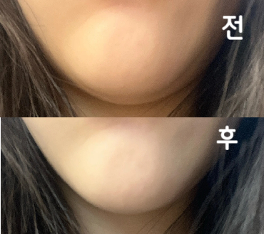 침샘보톡스 첨이라 효과는 기다려봐야 알 것 같아요~
