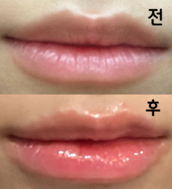 작년에 다른 병원에서 맞았던 것보다 훨씬 티 나서 좋았어요!!