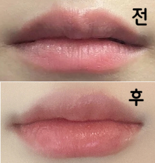 시술 끝나자마자 바로 친구들한테 사진 보내면서 자랑했어여!!! 첫 입술필러지만 여기에 정착하려구요!!