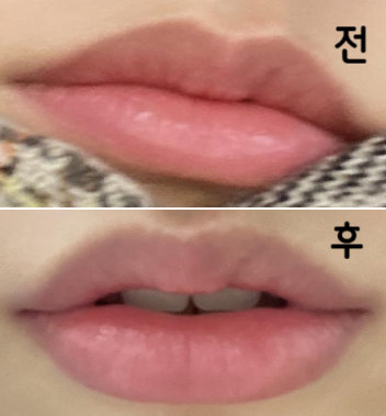 필러로 입꼬리 모양 잡아주니까 힘을 뺀 평상시에도 자연스럽게 올라간 모양이 된 너무 만족스럽습니다 ㅎㅎ