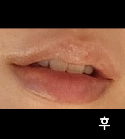 입술필러 하러가서 이렇게 최상의 서비스를 받은 적은 처음이에요!