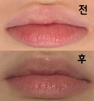 지금은 필러도 다 잘 녹았고 부작용  없었어용!!