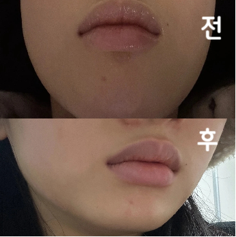 2회차까지 무사히 받고 왔어요. 체계적인 병원이라 그런지 진행도 빠르고 좋아요~