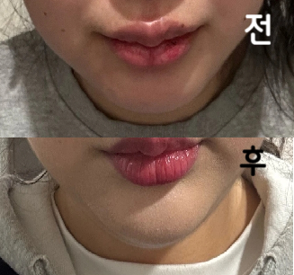제가 원하는 시술 방향으로 꼼꼼하게 너무 잘 놔주십니다 ㅠㅠ