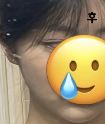 효과 좋았어요!! 광대 우락부락한 느낌이 사라졌대요!!