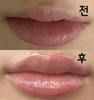 거울 보면서 같이 디자인 잡으면서 시술 했습니다! 멍이 살짝 들긴 했는데 너무 만족합니다!!
