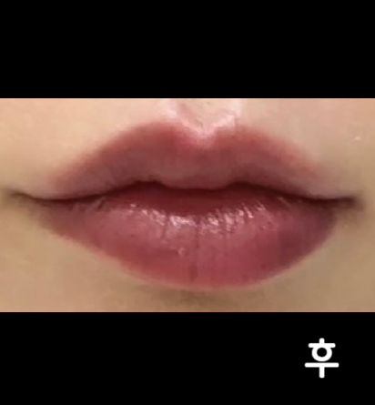 상담쌤 너무 친절하시고 의사쌤도 모양을 매우 예쁘게 잘 만들어주셔서 너무 만족해요~