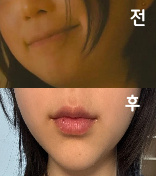 와 벌써부터 효과가 나타나는 것 같아요.. 여태 맞은 주사 중 단연 최고시다..