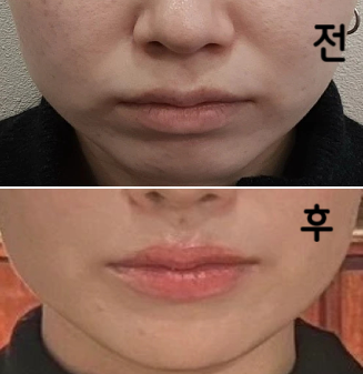 일주일 정도 지나니까 팔자필러도 익숙해져서 부드럽게 웃을 수 있고 턱이 생긴 것도 기쁩니다 ^^