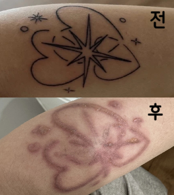 아프긴하지만 여기서 3회차정도 받았는데 지워지는게 점점 보여서 꾸준히 받을 예정입니당~