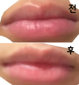 다른 곳에서 맞은 필러보다 더 오래가고 모양도 예쁘게 잡혀서 추천합니당!