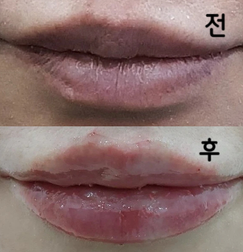 납작한 입술이 살아났어요!! 통증이 서투른사람에게도 추천합니다!!